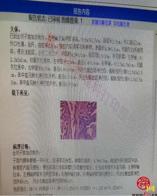 微创技术再上新台阶济南市四院成功完成两例腹腔镜下子宫内膜癌分期