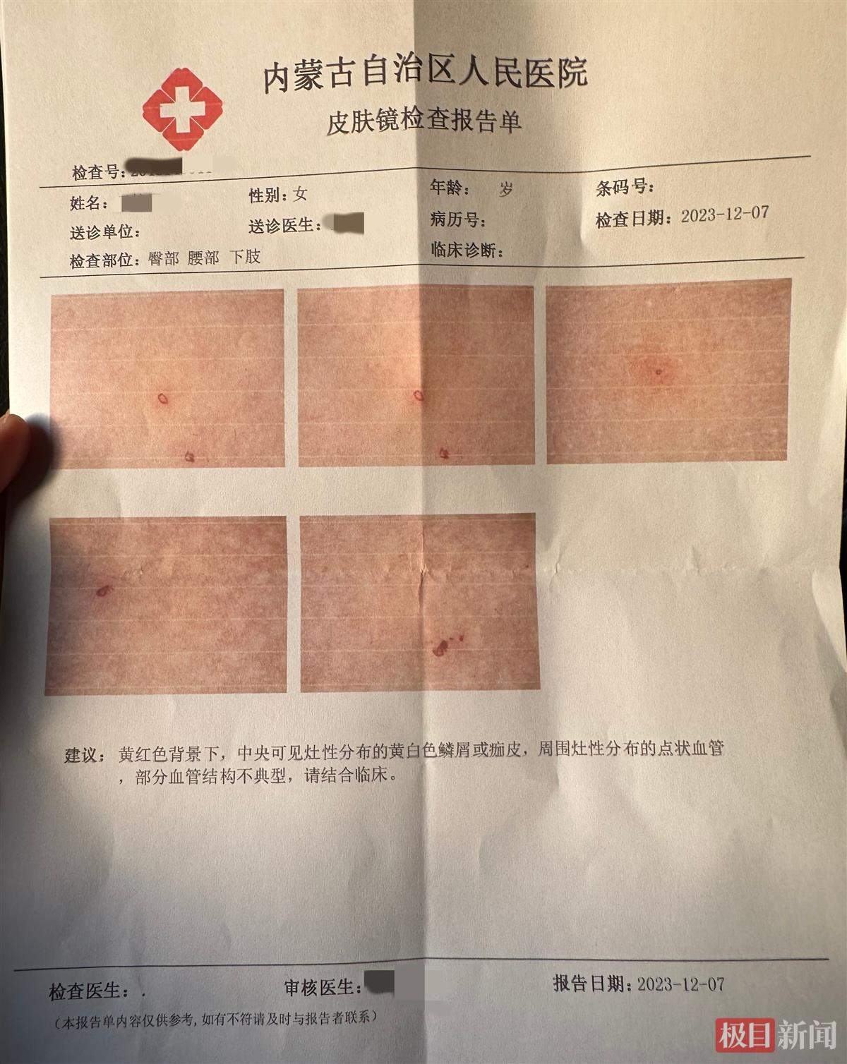 内蒙古一家长怀疑3岁女儿在幼儿园遭针扎该园两教师曾因针扎幼儿获刑
