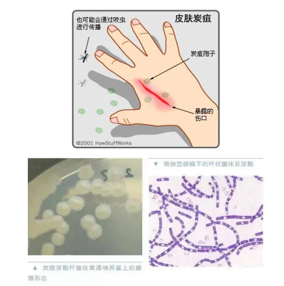 人间炭疽病例,以皮肤炭疽最为常见,多为散发病例,肺炭疽及肠炭疽发病