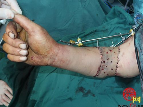 争分夺秒齐鲁医院成功完成高难度复杂断臂再植